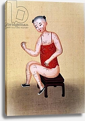 Постер Школа: Китайская 19в. Child with smallpox 1