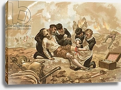 Постер Планелла Коромина Хосе Ambroise Pare, who introduced the ligature of arteries