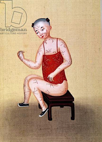 Постер Child with smallpox 1 с типом исполнения На холсте без рамы