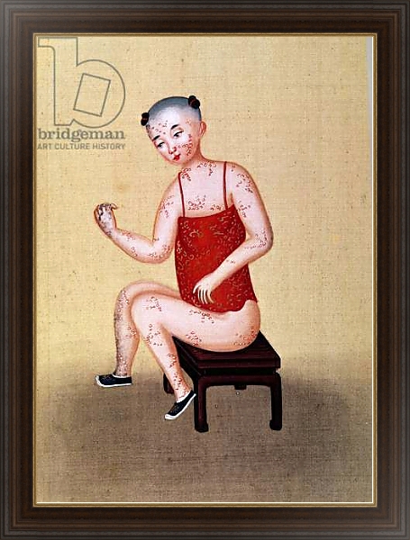 Постер Child with smallpox 1 с типом исполнения На холсте в раме в багетной раме 1.023.151