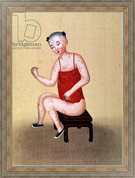 Постер Child with smallpox 1 с типом исполнения На холсте в раме в багетной раме 484.M48.310