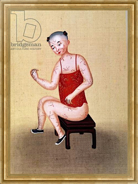 Постер Child with smallpox 1 с типом исполнения На холсте в раме в багетной раме NA033.1.051