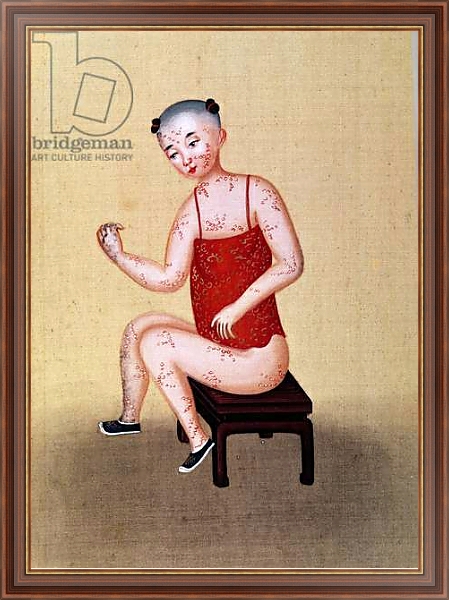 Постер Child with smallpox 1 с типом исполнения На холсте в раме в багетной раме 35-M719P-83