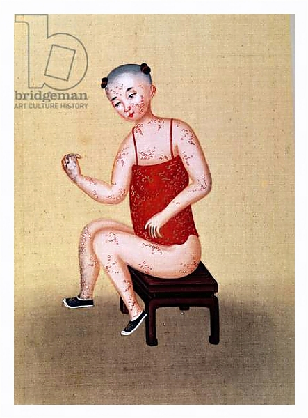 Постер Child with smallpox 1 с типом исполнения На холсте в раме в багетной раме 221-03