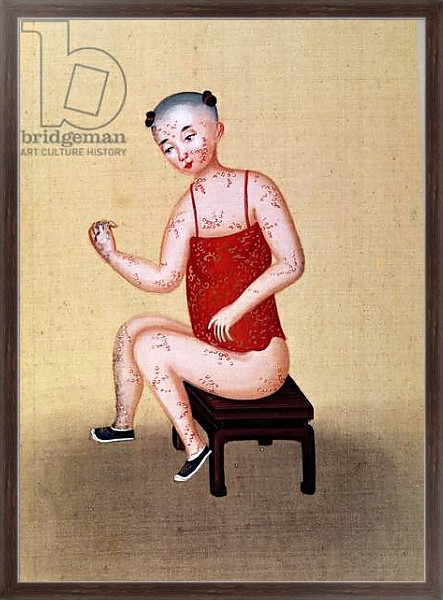 Постер Child with smallpox 1 с типом исполнения На холсте в раме в багетной раме 221-02